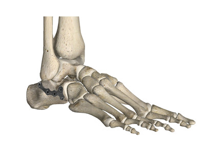 解剖型金属接骨板-跟骨接骨板（跟骨锁定板）