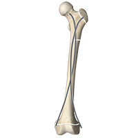 CareFix orthopedic pin,Elastic Intramedullary Pin