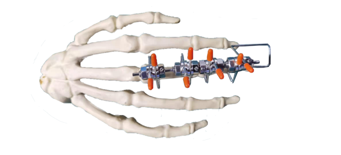 指掌骨构型 (1).png