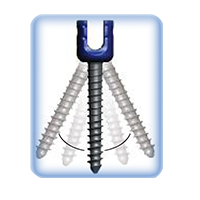 CareFix orthopedic spinal Posterior Thoracolumber Screw-Rod System